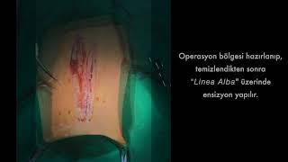 Böbrek Üstü Bezi Tümörü Uzaklaştırma - Adrenal Gland Tumor Removal (Adrenalectomy) - Kürşat Özer