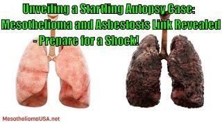 An Autopsy Case Of Malignant Mesothelioma Associated With Asbestosis