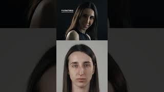 «Теперь лицо стало более женственным». Ринопластика. Зазыбо Н. А.