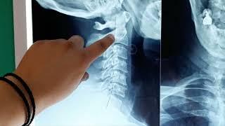 Radiografias cervicales comparativas