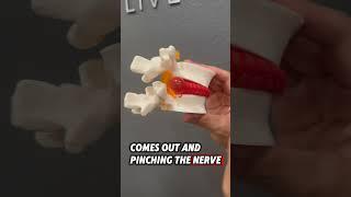 Got Disc Injury? Never Do This!!#chirowell #chiropractor #discinjury #neckpain #phoenixaz #drjae