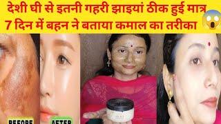 देशी घी से बने Facepack से किया कमाल झाइयां गई 100% Reduce Melasma,Pigmentation Discolouration