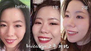 隐适美整牙2年啦！正面侧面大对比！invisalign简介／新手建议／一些感受