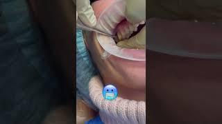 #удалениезуба #стоматология #клиникамосква #имплантация #имплантация #tooth