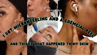 My Skin Transformation after Microneedling + Chemical Peel | Procedure | Daily Updates | Skincare...