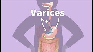 Cirrhosis – Varices