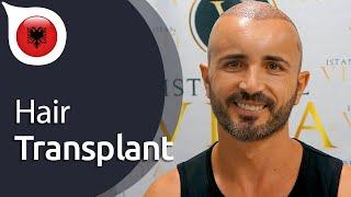 My Experience with Istanbul Vita from Albania | Hair Transplant in Istanbul / Turkey