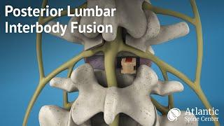 Posterior Lumbar Interbody Fusion (PLIF)