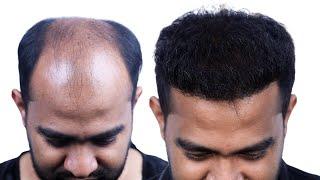 Grade 7 Hair Transplant Results Bangladesh | New Roots Hair Transplant |