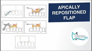 APICALLY REPOSITIONED FLAP/ PERIODONTAL FLAP SURGICAL TECHNIQUE/ DR. ANKITA KOTECHA