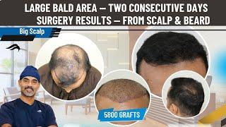 Hair Transplant In Bangalore | Best Surgeon Results & Cost Of Hair Transplant In Bangalore