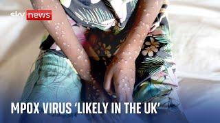 Experts warn deadly mpox virus is 'quite likely' in the UK