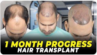 Hair Transplant in Sambhaji Nagar | Best Results & Cost of Hair Transplant in Sambhaji Nagar