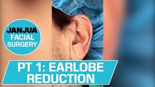 PART 1 - EARLOBE REDUCTION - DR. TANVEER JANJUA - NEW JERSEY