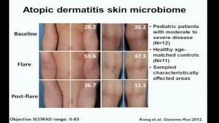 Eczema, Immunity and the Skin Microbiome - Heidi Kong