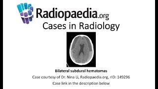 Bilateral subdural hematomas (Radiopaedia.org) Cases in Radiology