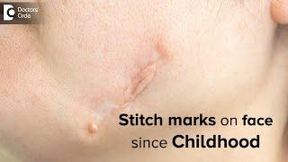 Stitch marks on face since Childhood. How to reduce this? - Dr. Rasya Dixit | Doctors' Circle