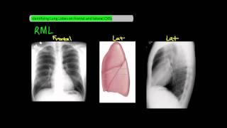 Identifying Lung Lobes on Frontal and Lateral Chest X-Rays [UndergroundMed]