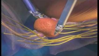 Surgery Animation: da Vinci Prostatectomy