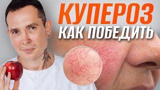 КУПЕРОЗ как победить | Полное пособие #купероз