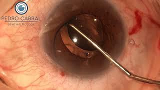 Sulcus implant IOL (3 pieces) after posterior capsular rupture By dr. Pedro Cabral