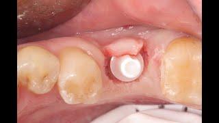 Placement and restoration of a Bone Level Z-Systems implant to Replace a Lower Molar