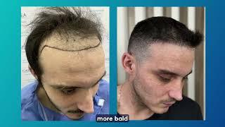 CAPILEA EXPERIENCE, HAIR TRANSPLANT.