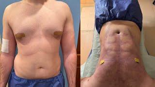 LEBO GYNO & BEYOND JUST FINISHED A AMAZING CASE OF GYNECOMASTIA & BEYOND ON OUR PATIENT 22 NEW YORK