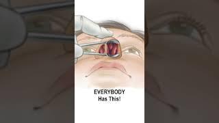 Nasal Obstruction Due to Turbinate Hypertrophy #shorts @fauquierent