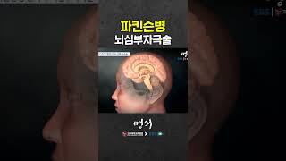 Parkinson's disease surgical treatment! deep brain stimulation