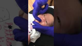 Suck Training following Laser Frenotomy (Tongue-tie and lip-tie release)