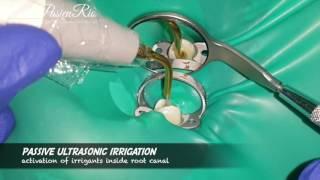 Restodontic treatment on mandibular premolar with gingivectomy (perawatan saluran akar gigi)