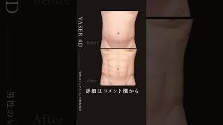 脂肪吸引1発でお腹バキバキ！！#shorts #腹筋 #筋トレ#脂肪吸引