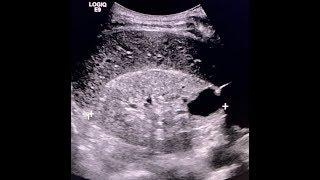 Ultrasound BASICS! CAN"T MISS!