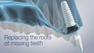 Modern Dental Implants