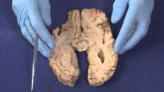 Basal Ganglia: Neuroanatomy Video Lab - Brain Dissections