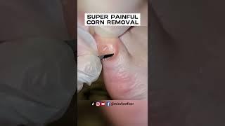 16 YEARS OLD SUPER PAINFUL CORN REMOVAL 2023 BY MISS FOOT FIXER