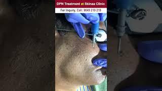 DPN Treatment at Skinaa Clinic #DPN #dpntreatment #reels #instareels #skinaa_clinic #skinaaclinic