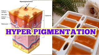 Ice Cubes For Hyperpigmentation and Acne Scars | Potato Ice Cubes for Skin Pigmentation