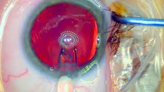 Visian ICL - One Port Implantation - Dr.med. Amir-Mobarez Parasta | MUNICH EYE