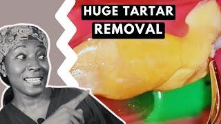 Massive TARTAR REMOVAL from teeth | TEETH CLEANING