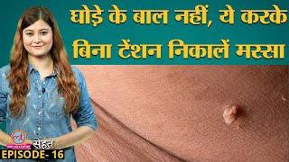 मस्से या Skin Tags आपकी Skin पर क्यों हो जाते हैं और इनसे कैसे निपटा जाए? Sehat Ep 16