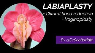 LABIAPLASTY + CLITORAL HOOD REDUCTION + VAGINOPLASTY by @DrScottsdale