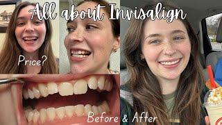 THINGS I WISH I KNEW BEFORE STARTING INVISALIGN | price, tips, before & after pics (Vlogmas Day 1)