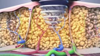 non surgical lipo animation