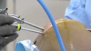 Arthroscopic Knee Surgery ACL Double Bundle Reconstruction Dr. Eric W. Janssen