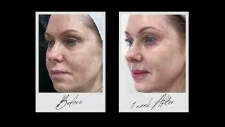 Laser Skin Resurfacing