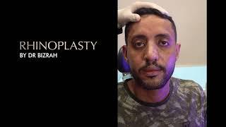  A Patient Speaks on Their Nose Job Journey performed by Dr Bashar Bizrah 