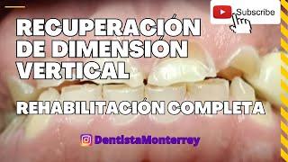 Recuperación de DV Dimensión Vertical  Rehabilitación Completa