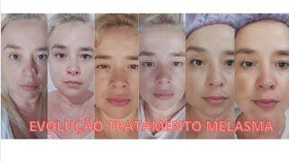 Melasma 3ª Semama de tratamento seguindo orientação da dermatologista com o passo-a-passo